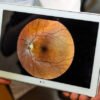 fundus camera price in India